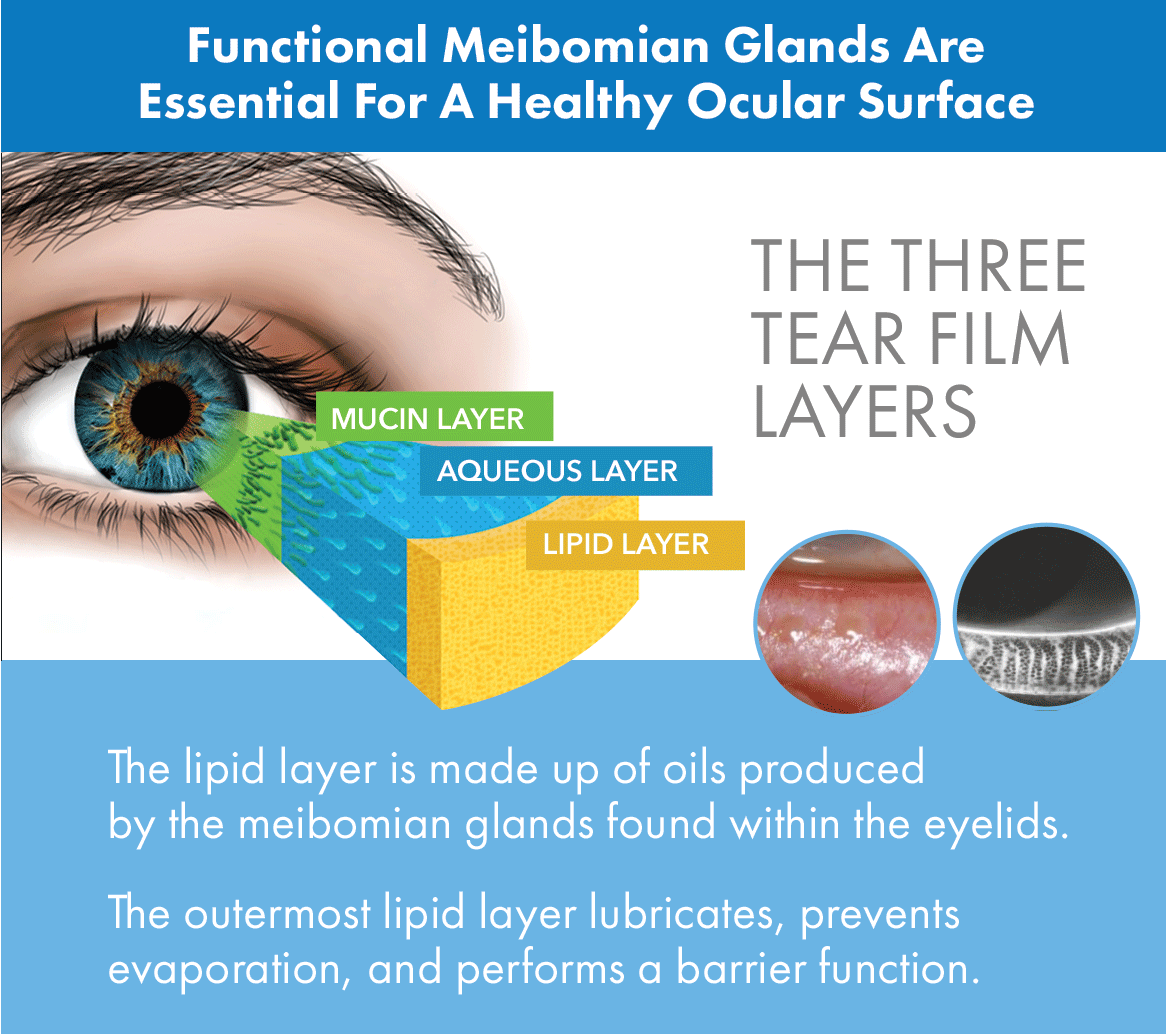 Most Dry Eye Syndromepatients Have Meibomian Gland Dysfunction Dr M 